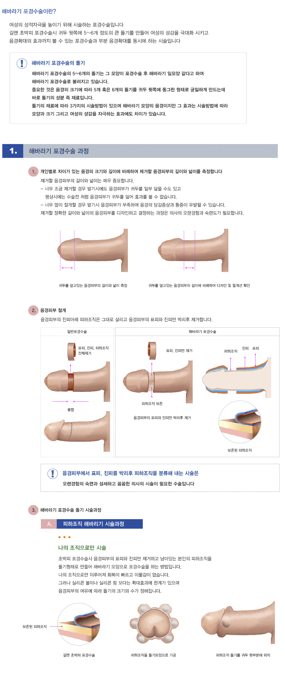 해바라기포경수술