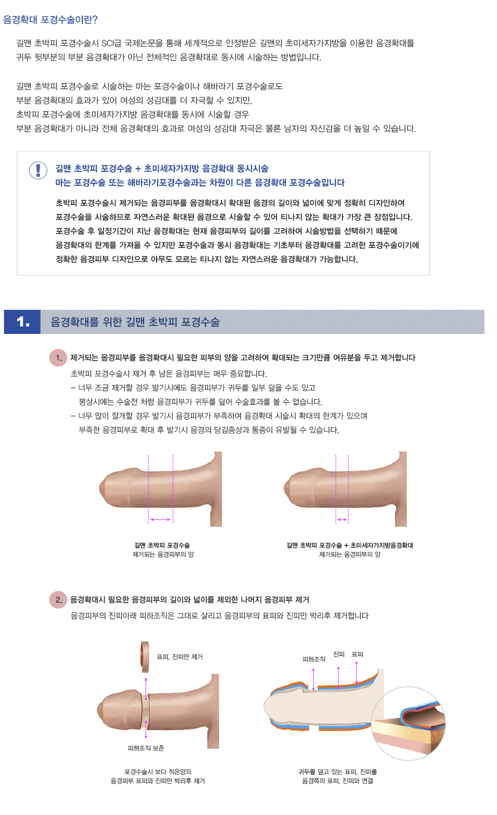 음경확대포경수술