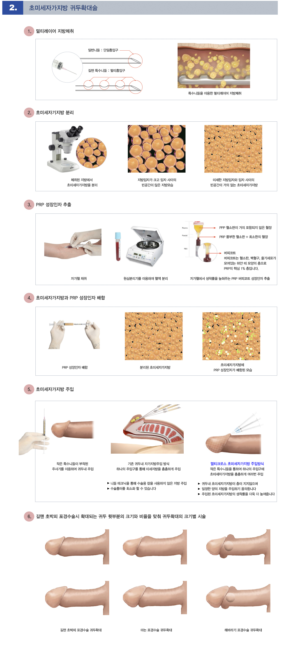 귀두확대포경수술